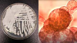 Deadly Candida auris fungus spreading across the US leaves agencies puzzled