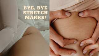 Exclusive | 5 dermatologist-approved treatments to get rid of stretch marks