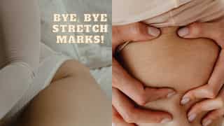 Exclusive | 5 dermatologist-approved treatments to get rid of stretch marks