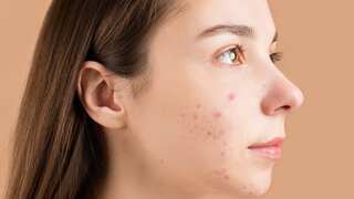 Exclusive: Dermatologist shares 7 tips to prevent breakouts and severe acne