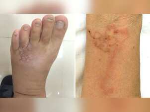 Vietnamese woman found worms crawling under skin after consuming blood pudding; pictures surface