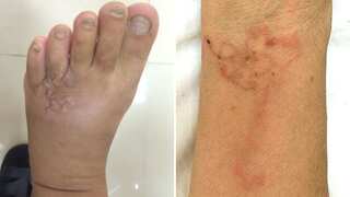Vietnamese woman found worms crawling under skin after consuming blood pudding; pictures surface