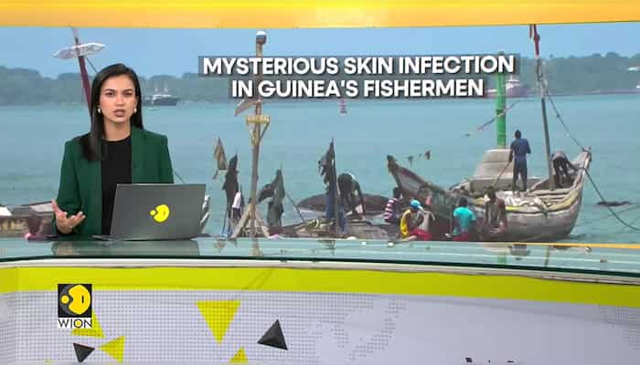 Over 50 fishermen in Guinea hospitalised due to unknown skin ailment