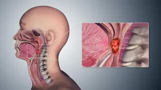 Oral sex emerges as major risk factor for throat cancer, claims study