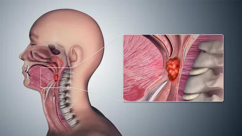 Oral sex emerges as major risk factor for throat cancer, claims study