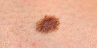 The 'smallest detected skin cancer' turned out to be melanoma. Know its symptoms
