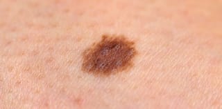 The 'smallest detected skin cancer' turned out to be melanoma. Know its symptoms
