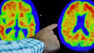 Alzheimer's disease slowed down by a third with this new breakthrough medicine