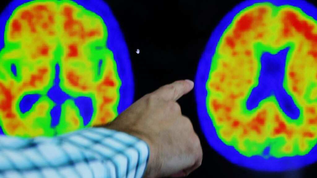 Alzheimer's disease slowed down by a third with this new breakthrough medicine