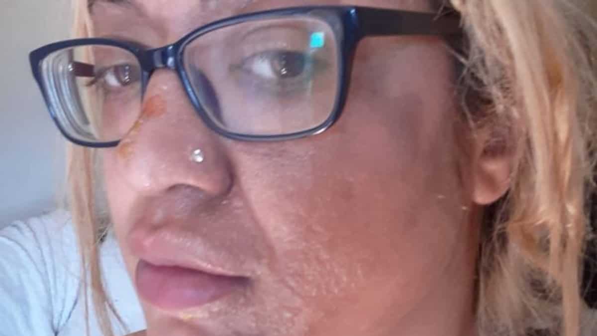 Shocking: Woman's face peels off in horrifying accident while trying TikTok cooking hack