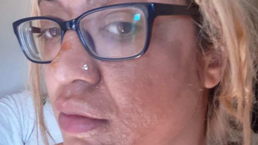 Shocking: Woman's face peels off in horrifying accident while trying TikTok cooking hack