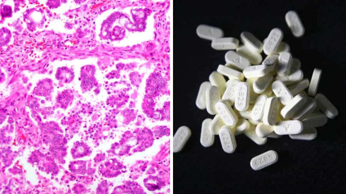 Ovarian cancer breakthrough? Drug combination shrunk tumours in nearly half of patients