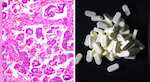 Ovarian cancer breakthrough? Drug combination shrunk tumours in nearly half of patients
