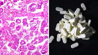 Ovarian cancer breakthrough? Drug combination shrunk tumours in nearly half of patients