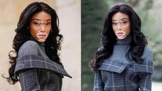 World Vitiligo Day 2023: Doctor's advice, causes, symptoms and treatment of this skin disorder