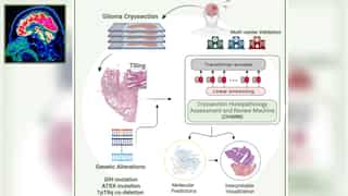 This AI tool can help doctors treat brain tumours quickly and accurately, study finds