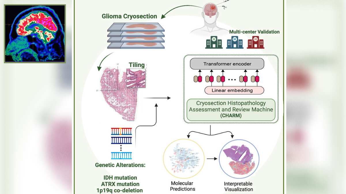 This AI tool can help doctors treat brain tumours quickly and ...