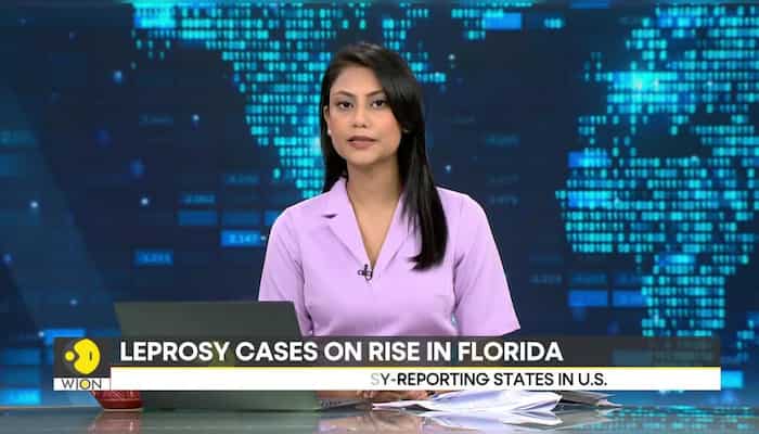 US Health authorities issue Leprosy warning