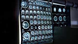 Researchers identify brain region crucial for attention control