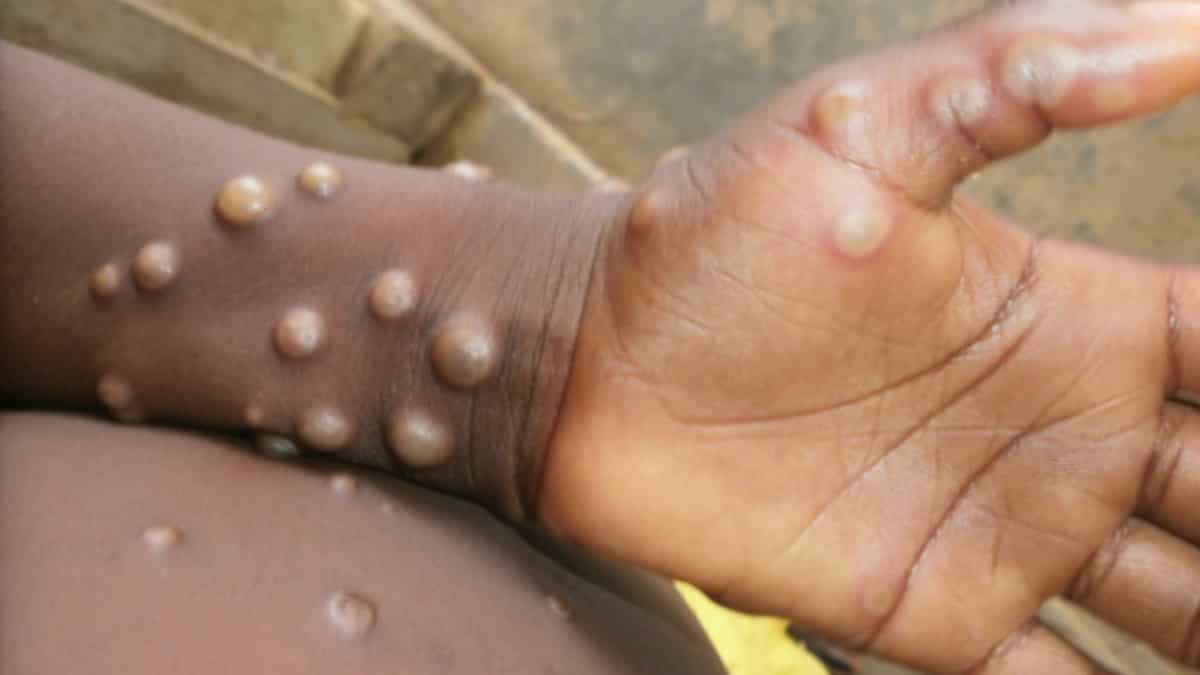 Mpox scare: Indian govt tells international airports to be vigilant about passengers with symptoms