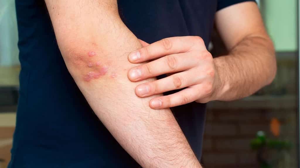 The gut-skin connection! Unravelling the link between bad gut health and psoriasis