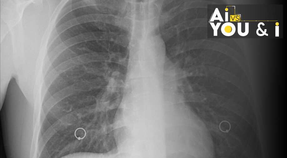 New AI model can accurately estimate age from chest X-rays, research says