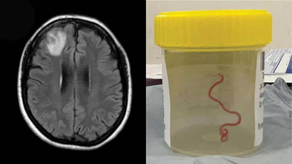 From snakes to humans: Live parasitic roundworm discovered in Australian woman's brain