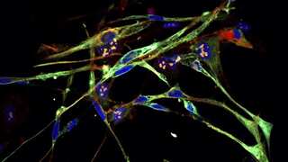 Scientists successfully induce aggressive cancer cells to transform into healthy cells