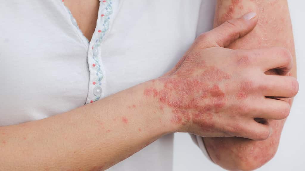 US slowly getting caught in proliferating skin-disfiguring infection?