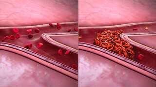 New hope for Sickle Cell Anaemia patients as FDA gives nod to Casgevy, Lyfgenia gene therapies