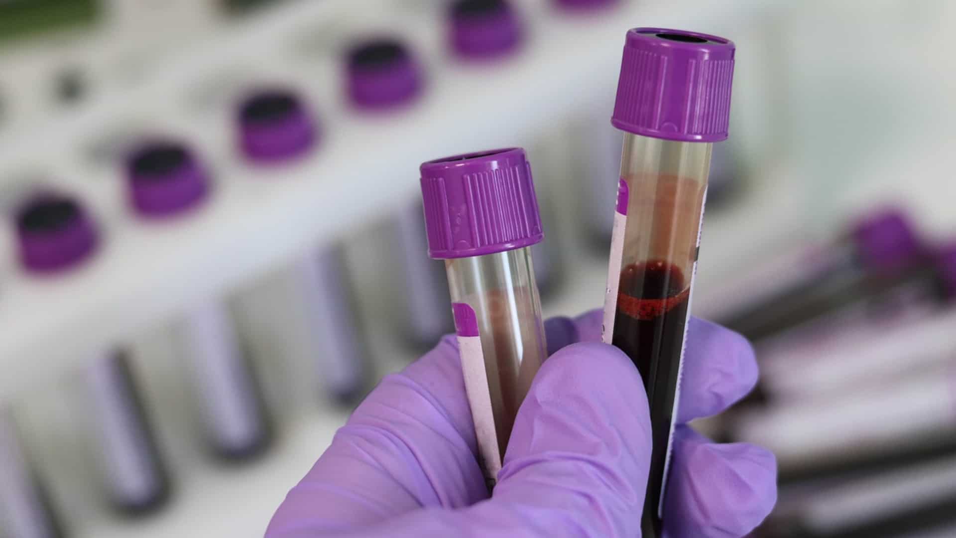 A simple blood test will now be able to diagnose bipolar disorder. Here's how A simple blood test will now be able to diagnose bipolar disorder. Here's how