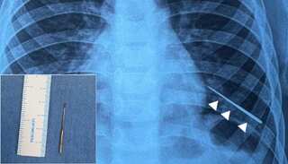 India: Doctors successfully remove needle from boy’s lungs by using magnet