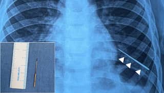 India: Doctors successfully remove needle from boy’s lungs by using magnet