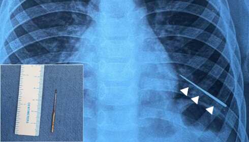 India: Doctors successfully remove needle from boy’s lungs by using magnet