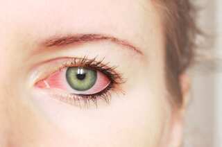 One man infects 5 women with rare eye syphilis following sexual intercourse