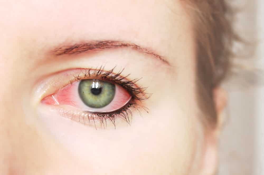 One man infects 5 women with rare eye syphilis following sexual intercourse