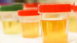 What makes urine yellow? Researchers have finally figured it out