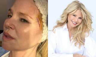 Actress Christie Brinkley reveals her basal-cell carcinoma diagnosis. Know what it is