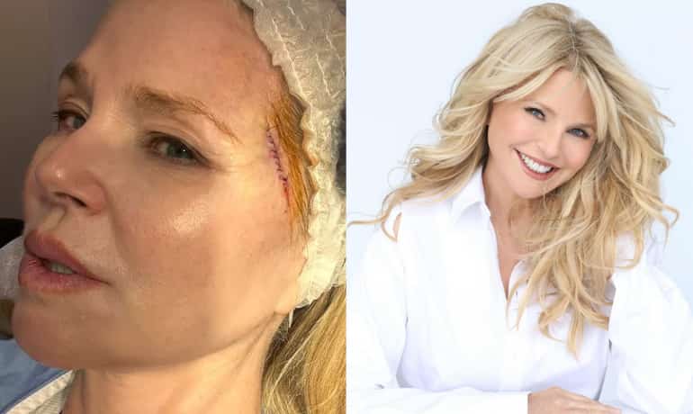 Actress Christie Brinkley reveals her basal-cell carcinoma diagnosis. Know what it is