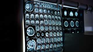AI can now analyse brain scans to detect anxiety in a person. It’s that simple