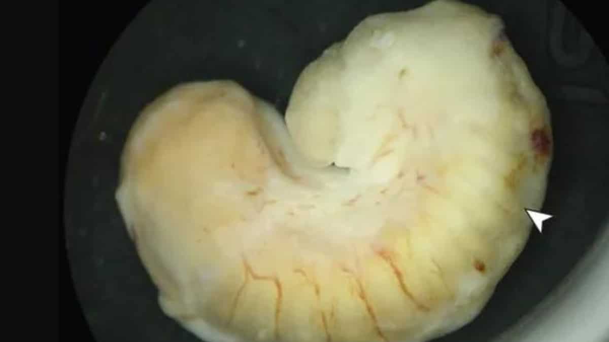 A parasite lived and grew in a woman's eye for two years. Doctors believe contaminated... A parasite lived and grew in a woman's eye for two years. Doctors believe contaminated...