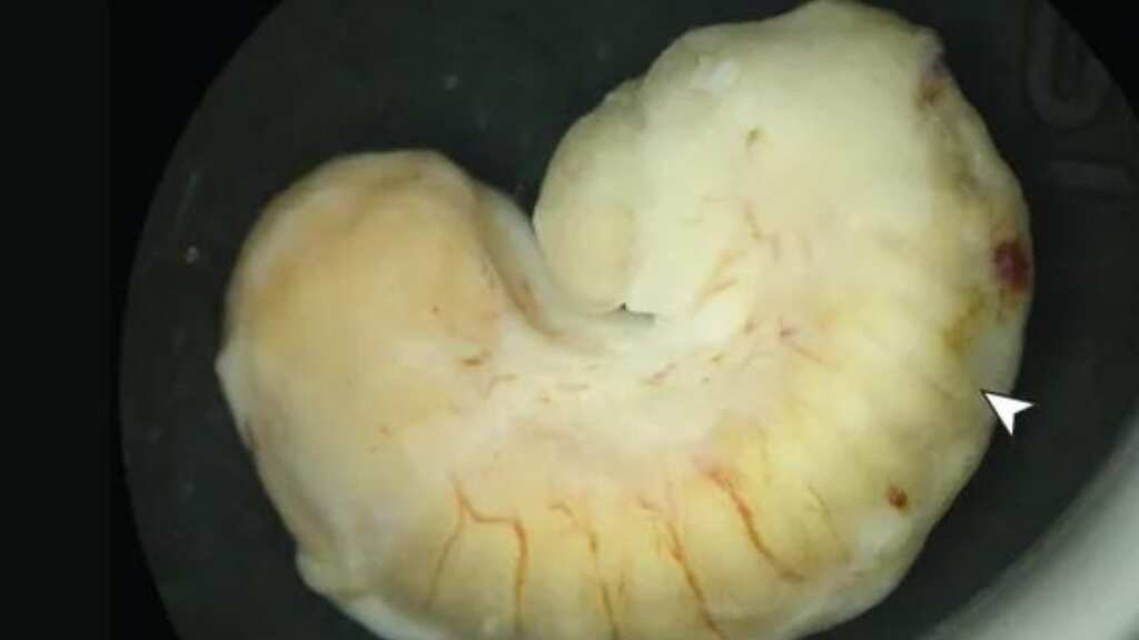 A parasite lived and grew in a woman's eye for two years. Doctors believe contaminated...