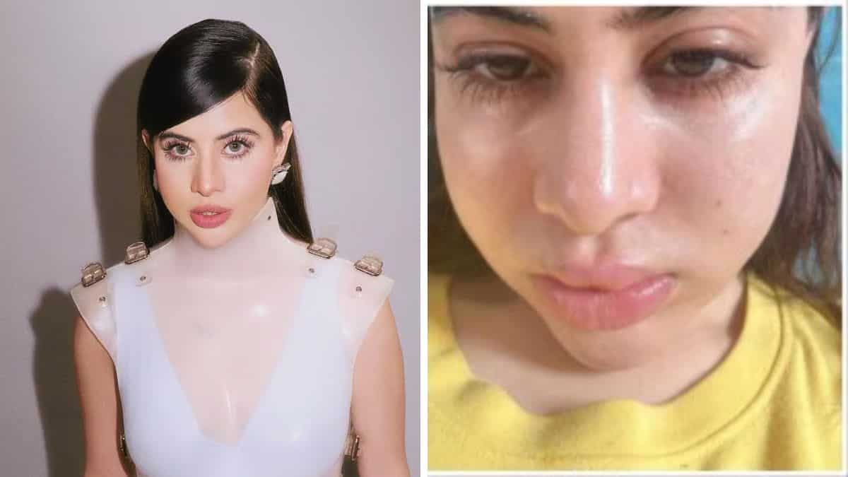 Uorfi Javed reveals she’s been getting fillers and botox since 18; opens up about swollen face
