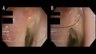 Bizzare! Rare hair grows inside throat of a man who smoked cigarettes for 30 years
