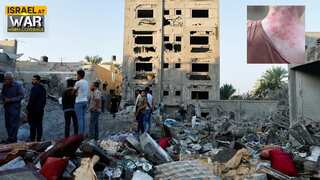 Skin diseases including lice and rashes running rampant in war-torn Gaza