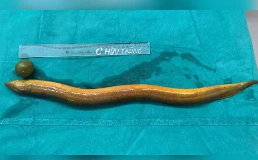 Indian man almost dies after inserting 65cm long eel up his anus to 'seek sensations'