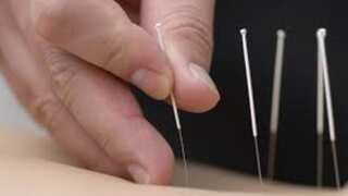 Woman learns acupuncture using online videos, induces heart failure in her patient