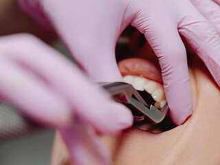 Study finds severe tooth loss linked to increased risk of heart disease