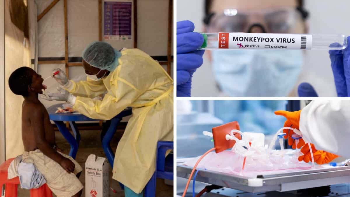 Mpox crisis updates: Pakistan adopts safety measures; WHO says no need to close borders