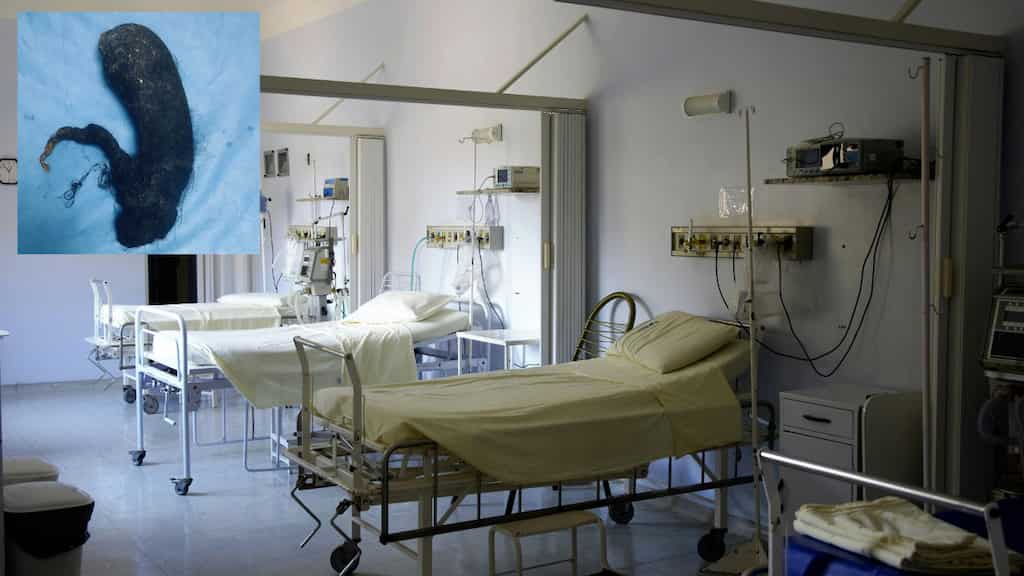 Surgeons remove 1.5 kg hair from teen's stomach in India's Puducherry